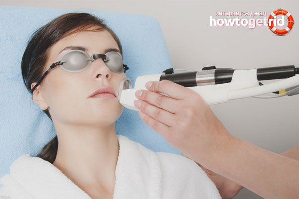 Electrocoagulation from spider veins