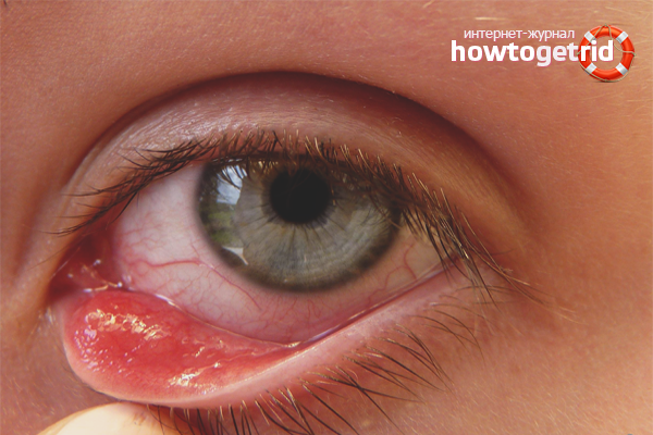 How to get rid of barley in the eye