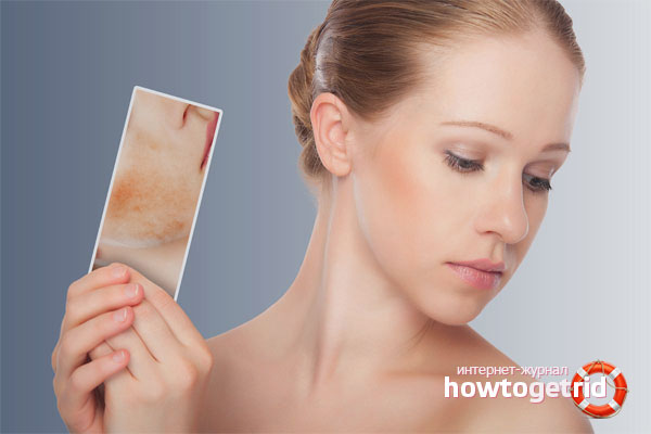 How to get rid of spider veins on the face