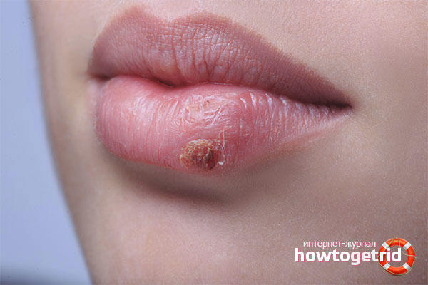 How to treat cold sores