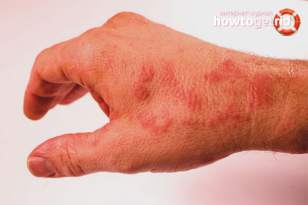 How to get rid of urticaria