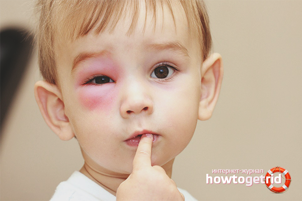 First aid after a wasp sting