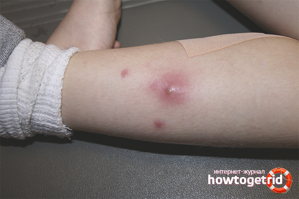 How to get rid of a boil