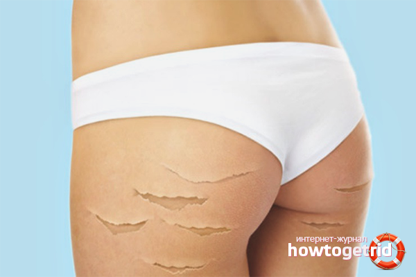 How to get rid of stretch marks on the legs