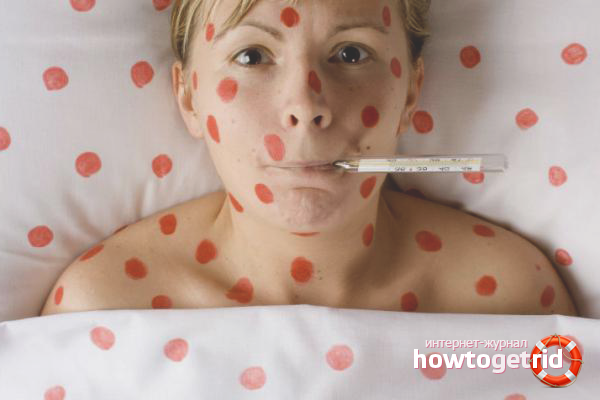 How to treat chickenpox in adults