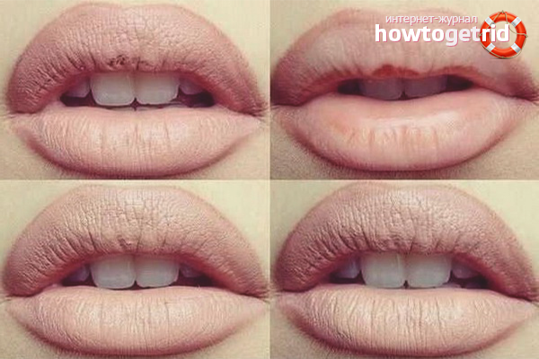 How to increase lips at home