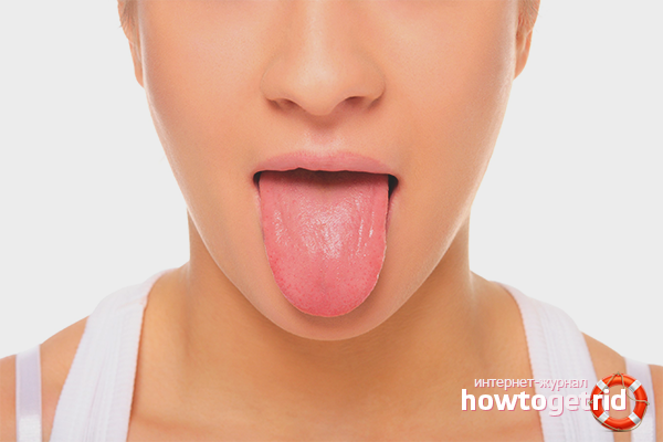 Definition of disease by plaque in the tongue