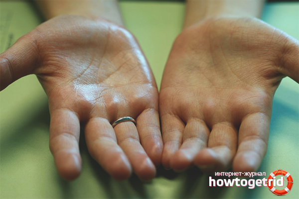 Hand hyperhidrosis treatment