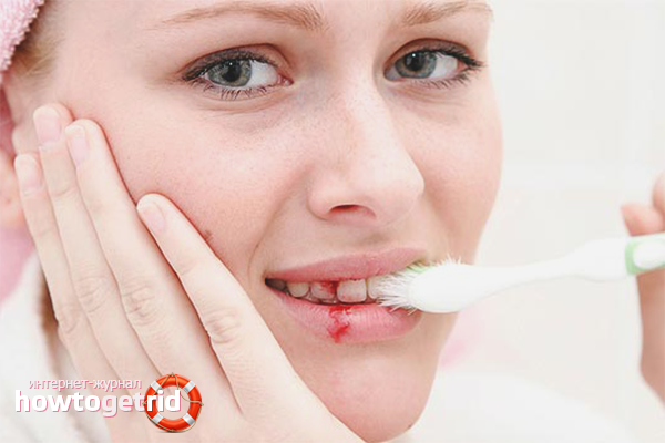 How to get rid of bleeding gums