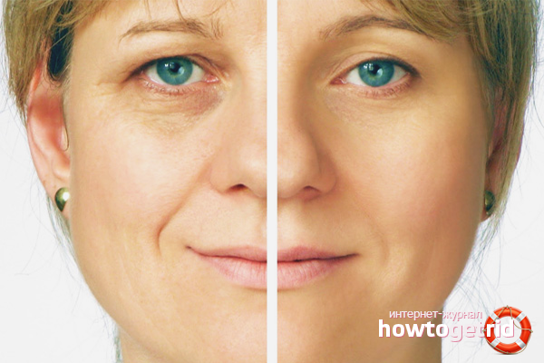 How to remove bryly on the face