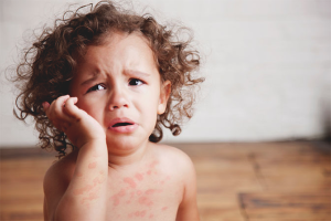 How to treat urticaria in children