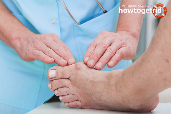 How to get rid of a bone on the thumb