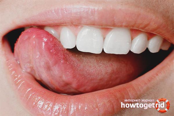 Comment se débarrasser de l'acné dans la langue