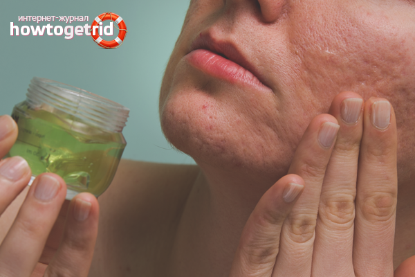 How to get rid of acne scars