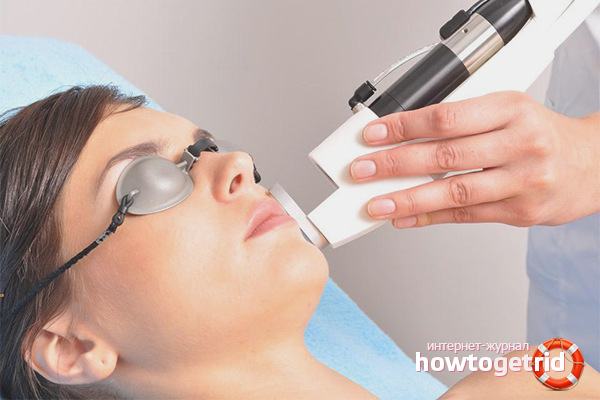 How to get rid of freckles with a laser