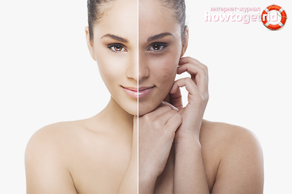 How to remove acne marks