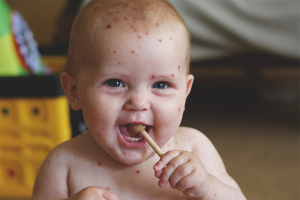 Chickenpox in children