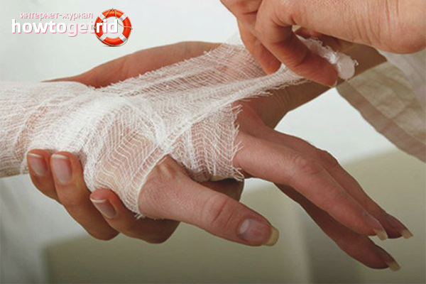 Wie man Schmerzen nach einer Verätzung loswird