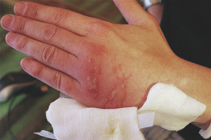 How to relieve burn pain