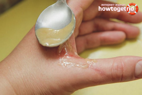 Volksheilmittel gegen Verbrennungen