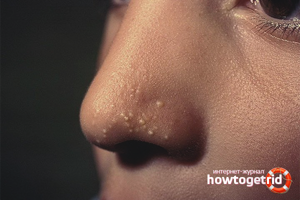 How to get rid of white dots on your face