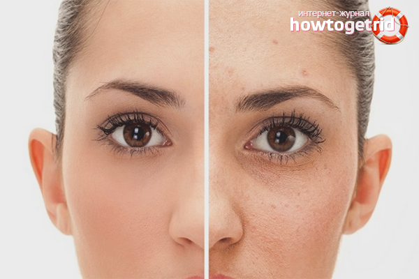 How to get rid of acne in 1 day