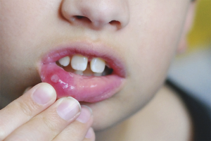 How to treat stomatitis in a child
