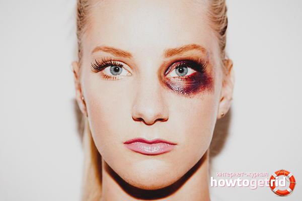 Comment réduire un œil au beurre noir