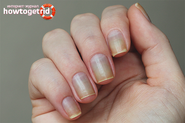 How to restore nails after gel polish