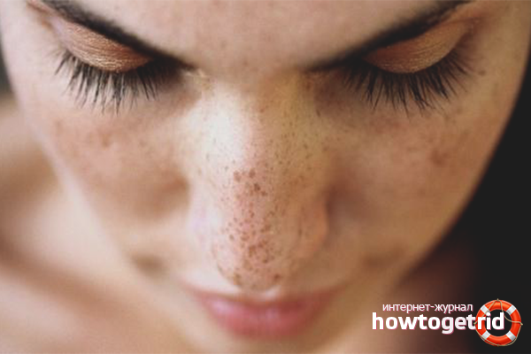 How to remove age spots on the face