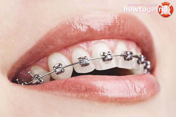 Braces for teeth alignment