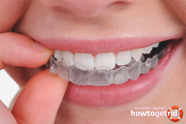 Aligners for aligning teeth
