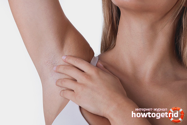 How to get rid of papillomas under the armpits