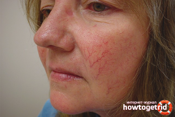 How to treat rosacea on the face