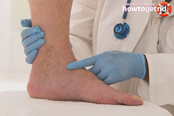 How to treat lower limb thrombophlebitis