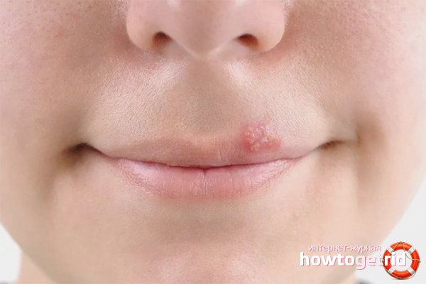 Comment guérir les boutons de fièvre sur les lèvres