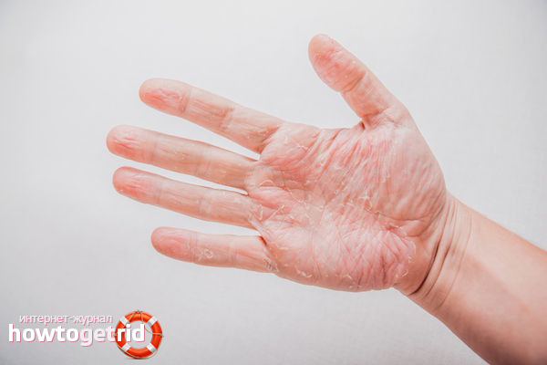 Comment guérir l'eczéma sur les mains