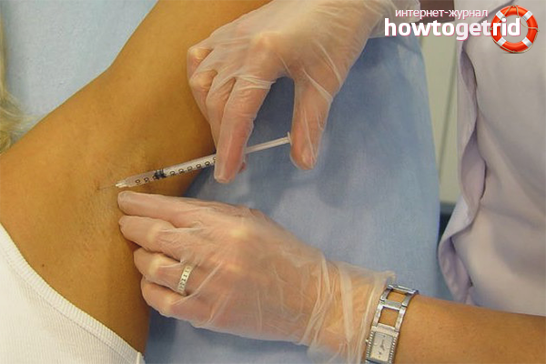 Professional treatment of hyperhidrosis