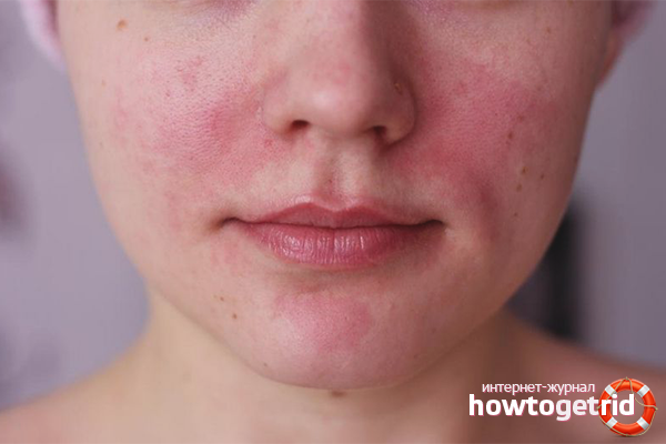 How to get rid of rosacea on the face