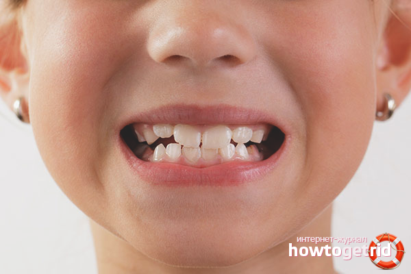 How to strengthen baby teeth