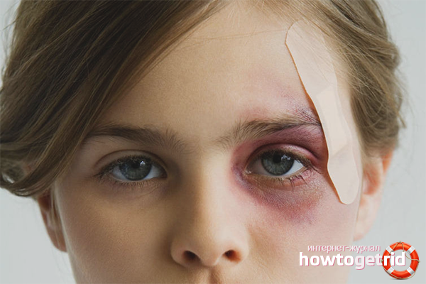 So entfernen Sie schnell ein blaues Auge