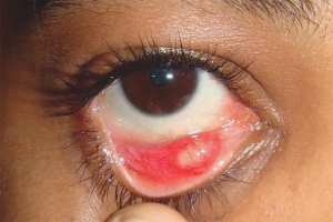 How to treat barley in the eye of a child