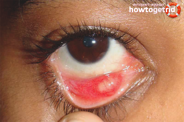 Wie man Gerste im Auge eines Kindes behandelt