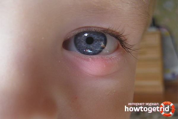 Wie man Gerste bei einem Kind behandelt