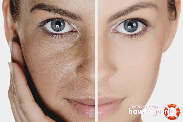 Enlarged pores on the face