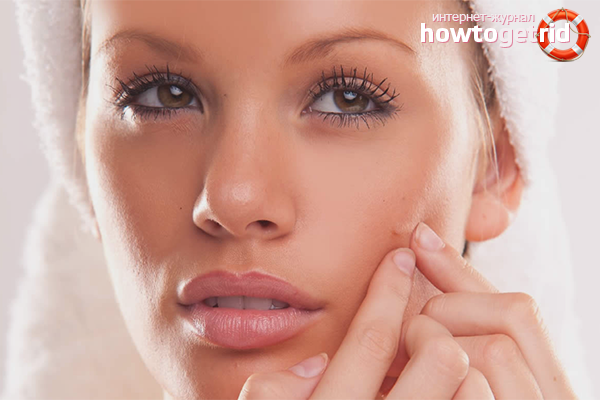 Acne on the cheeks of women