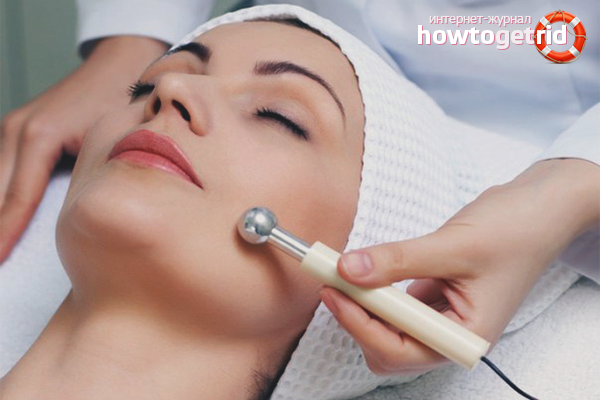 Acne Scar Removal