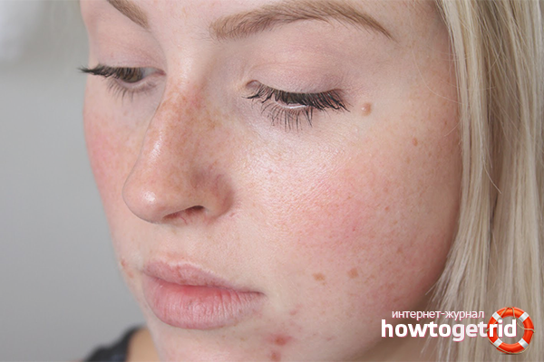 How to remove acne marks on your face