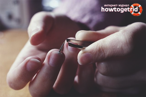 Wie man einen Splitter unter dem Nagel hervorzieht