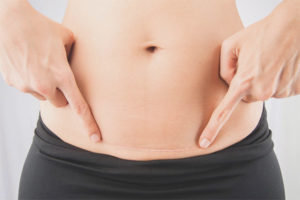 How to handle a suture after cesarean section